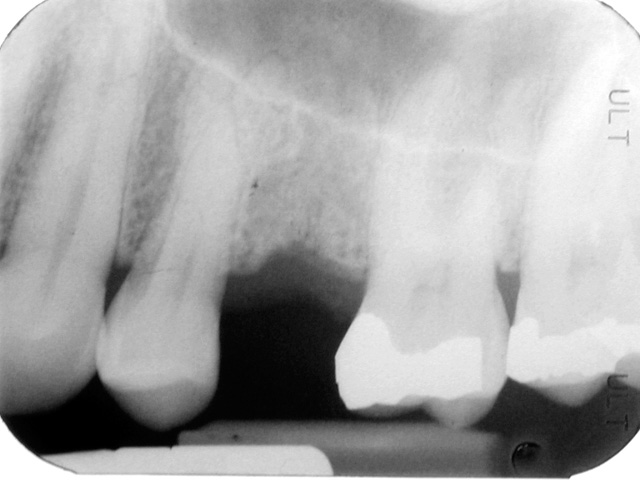 Dental Implant