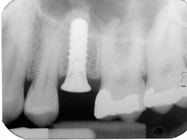 Dental Implant